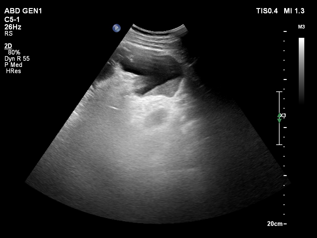 Pyonephrosis | Image | Radiopaedia.org