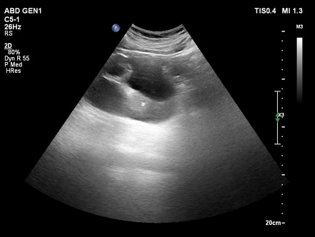 Pyonephrosis | Image | Radiopaedia.org