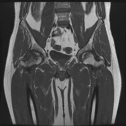 Avascular necrosis - bilateral femoral heads | Radiology Case ...