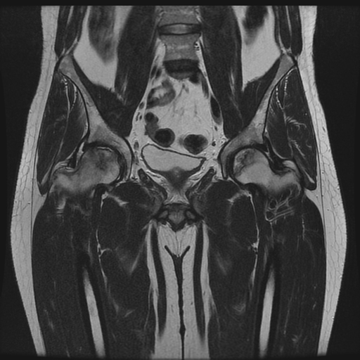 Avascular necrosis - bilateral femoral heads | Image | Radiopaedia.org