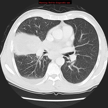 Undifferentiated large cell carcinoma | Image | Radiopaedia.org