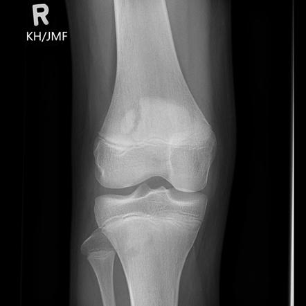 Bipartite Patella | Radiology Case | Radiopaedia.org