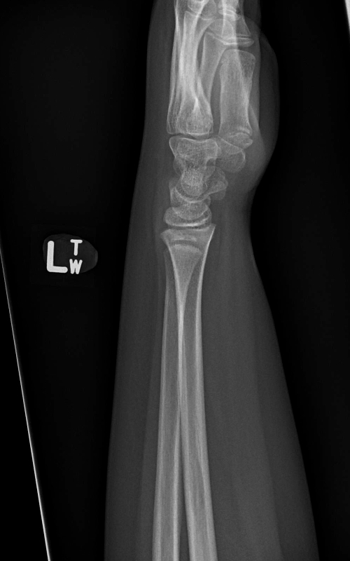 Cleft ulnar epiphysis | Image | Radiopaedia.org