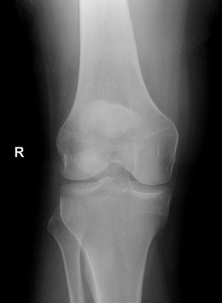 Patella fracture | Radiology Case | Radiopaedia.org