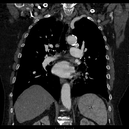 Bronchial Arterial Aneurysm 