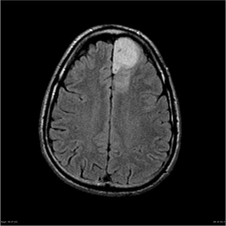 Playlist 'RMH Neuroradiology Neuropathology #01' by RMH Neuropathology