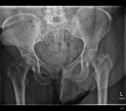 Osteomyelitis | Radiology Reference Article | Radiopaedia.org