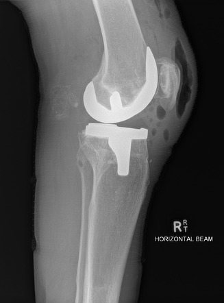 Calcified loose bodies in a Baker cyst | Radiology Case | Radiopaedia.org