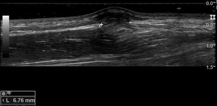 Tibialis Anterior Muscle Herniation