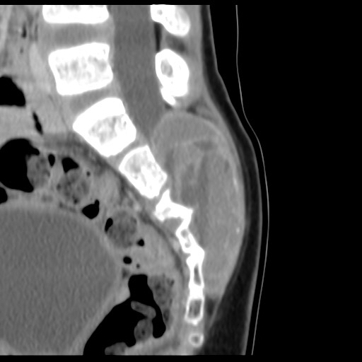 Aneurysmal Bone Cyst Sacrum Image