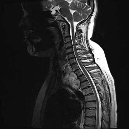 Chondrosarcoma - chest wall | Image | Radiopaedia.org