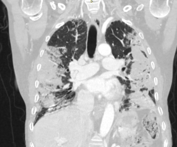 Cryptogenic Organizing Pneumonia Image Radiopaedia Org