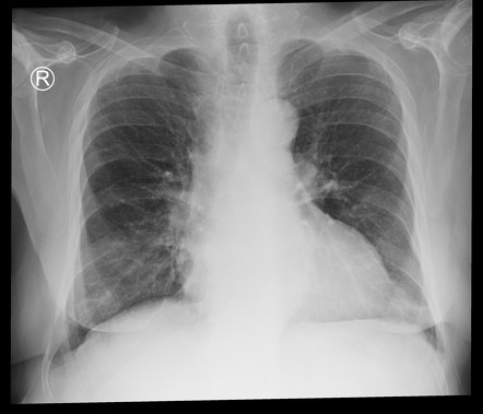 Button artifact (chest x-ray) | Radiology Case | Radiopaedia.org