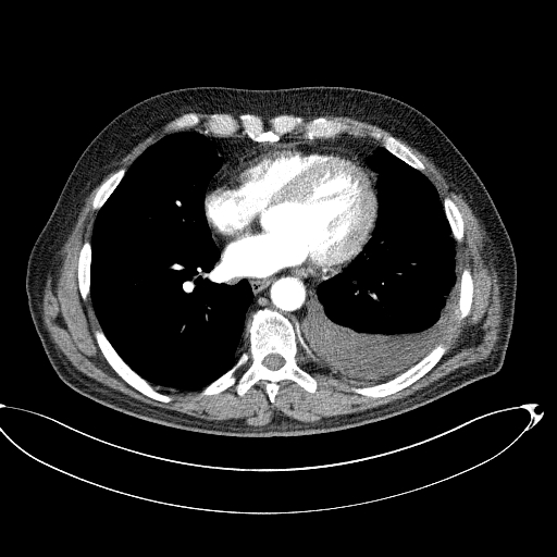 Post Traumatic Subpulmonic Effusion Image