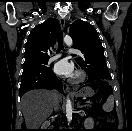 Post Traumatic Subpulmonic Effusion Image