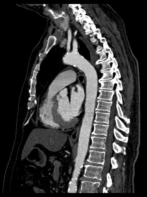 Post Traumatic Subpulmonic Effusion Image