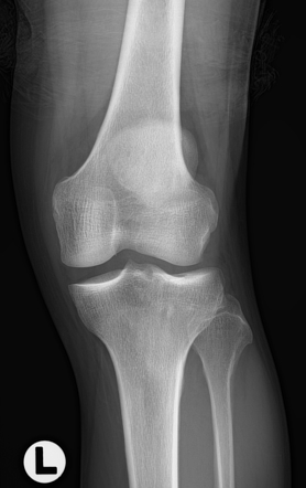 Tibial plateau fracture: Schatzker type IIIb | Image | Radiopaedia.org