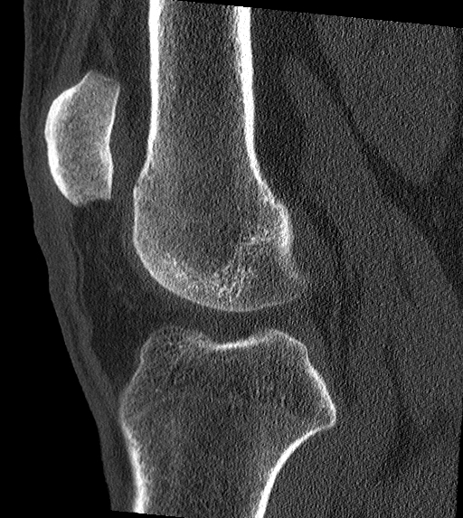 Tibial Plateau Fracture: Schatzker Type IIIb | Image | Radiopaedia.org