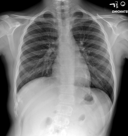 Ewings Sarcoma X Ray