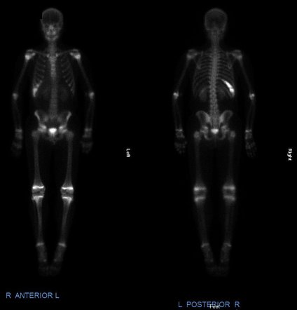 Ewing sarcoma (chest wall) | Radiology Reference Article | Radiopaedia.org