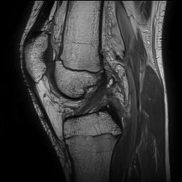 Hyperextension Knee Injury 