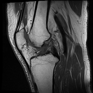 Baker cyst | Image | Radiopaedia.org