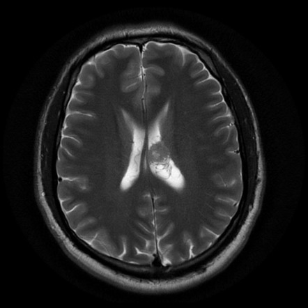 Central neurocytoma | Radiology Case | Radiopaedia.org