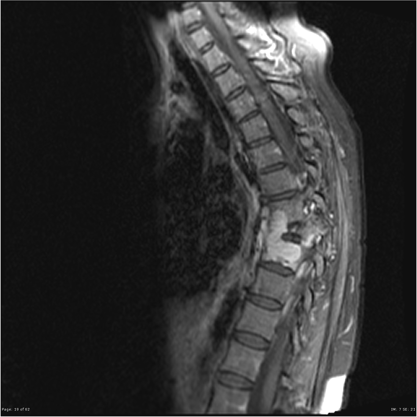 Plasmacytoma Multiple Myeloma Spine Image Radiopaedia Org