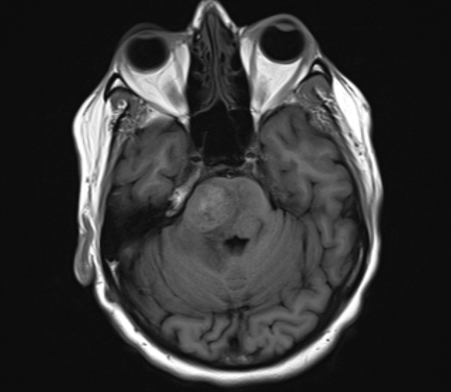 Metastatic melanoma - to brain | Image | Radiopaedia.org