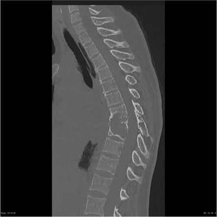 Plasmacytoma / multiple myeloma - spine | Radiology Case | Radiopaedia.org