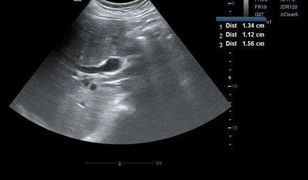 Post cholecystectomy cystic duct stump and CBD stones | Image ...