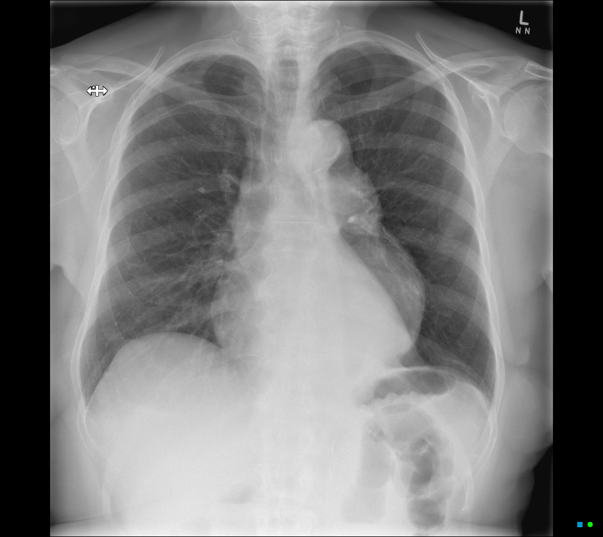 Aortic Aneurysm On Chest Radiograph Image