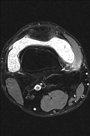 Knee rice bodies | Image | Radiopaedia.org