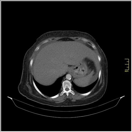 Elastofibroma dorsi - bilateral | Radiology Case | Radiopaedia.org