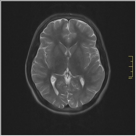 Intraocular lens implant subluxation | Radiology Case | Radiopaedia.org