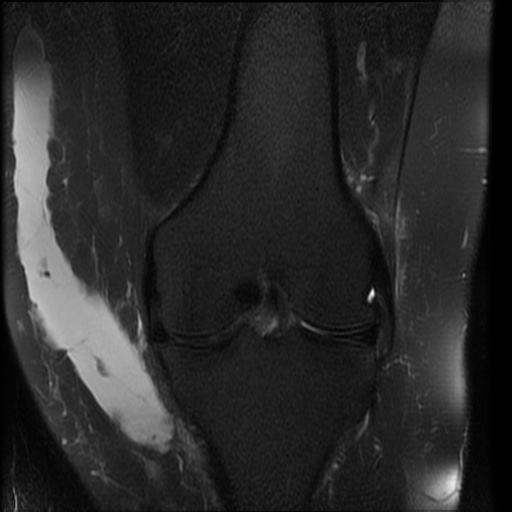 MorelLavallée lesion Image