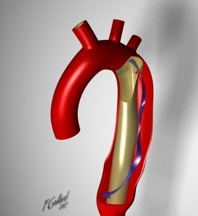 Aortic Dissection | Radiology Reference Article | Radiopaedia.org