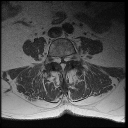 Epidural lipomatosis | Image | Radiopaedia.org