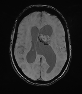 Central neurocytoma | Image | Radiopaedia.org