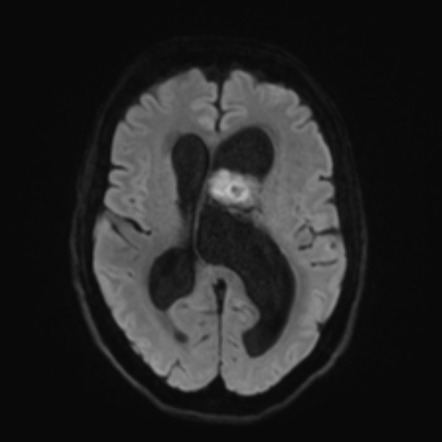 Central neurocytoma | Image | Radiopaedia.org