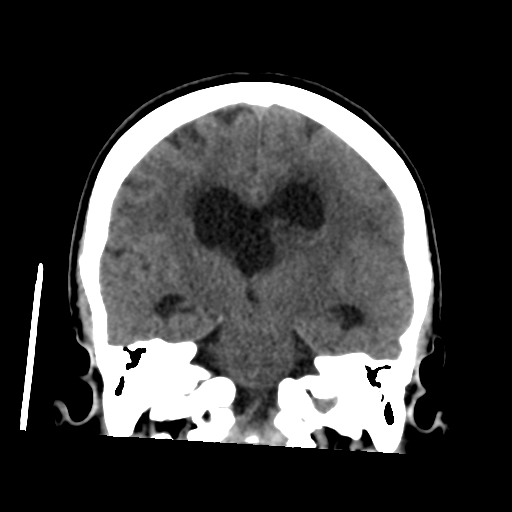 Central neurocytoma | Image | Radiopaedia.org