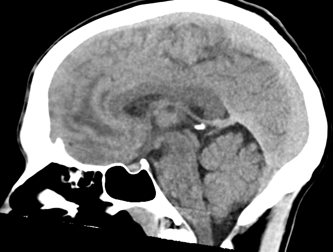 Acute disseminated encephalomyelitis (ADEM) | Image | Radiopaedia.org