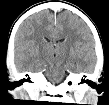 Acute disseminated encephalomyelitis (ADEM) | Image | Radiopaedia.org