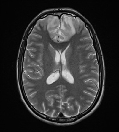 Acute disseminated encephalomyelitis (ADEM) | Radiology Case ...