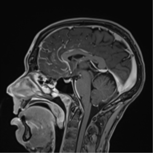 Acute disseminated encephalomyelitis (ADEM) | Image | Radiopaedia.org