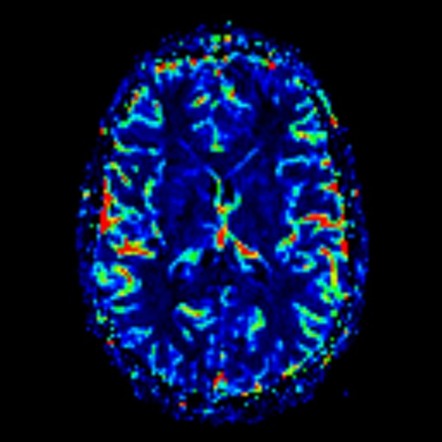 Acute disseminated encephalomyelitis (ADEM) | Image | Radiopaedia.org