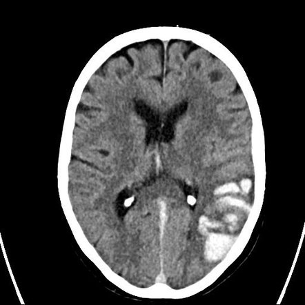 Cerebral venous infarction | Radiology Reference Article | Radiopaedia.org