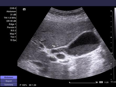 Choledocholithiasis | Image | Radiopaedia.org