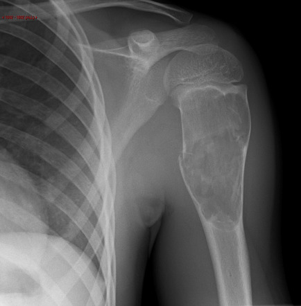 Fallen fragment sign | Radiology Case | Radiopaedia.org