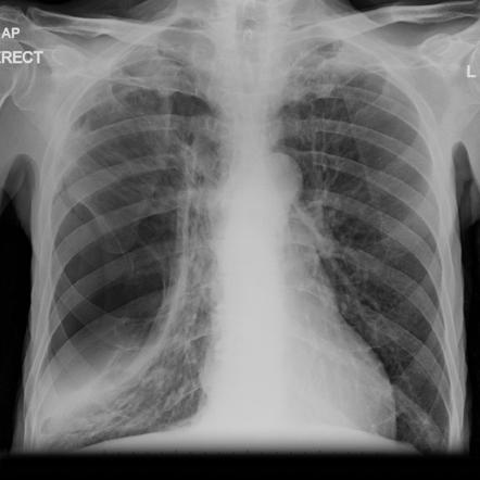 Pneumothorax Radiology Reference Article Radiopaedia Org